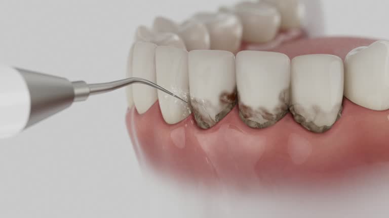 Reliable Dental Implants contractor in Minden, LA by Smile Center Dentistry